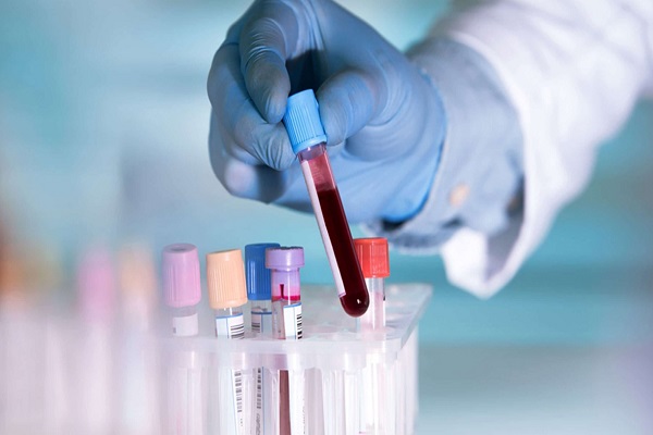 تفسیر آزمایش خون راهنمای کامل و ساده برای خواندن جواب آزمایش-درمان در منزل