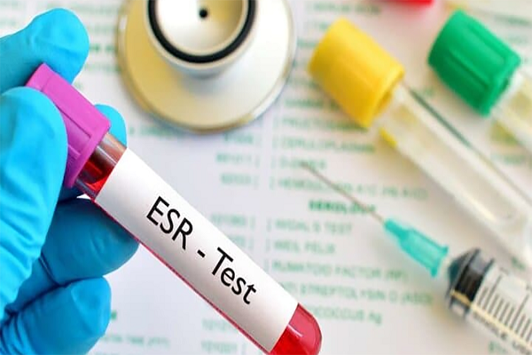 علامت BP در برگه آزمایش و میزان نرمال آن-درمان در منزل